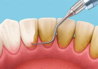 Teeth Cleaning