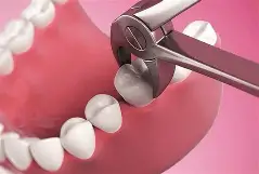 Wisdom Tooth