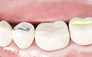 Fillings