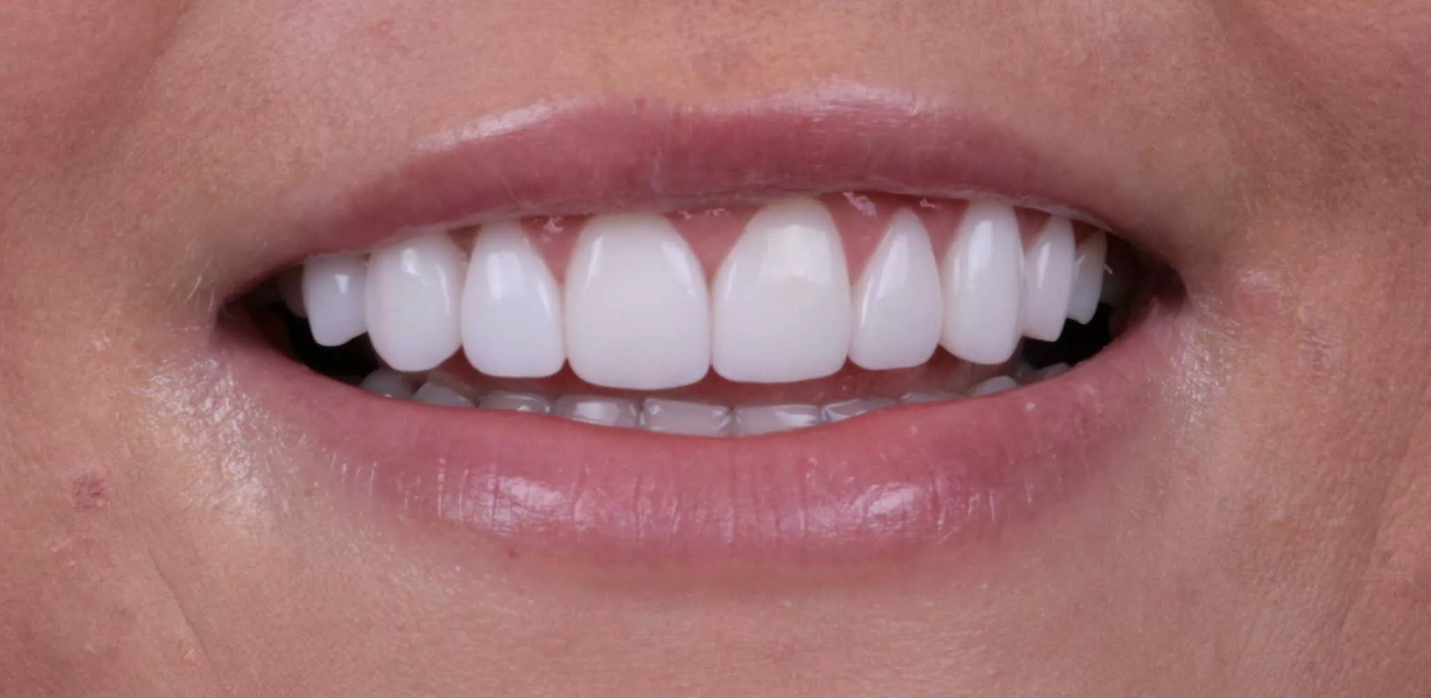 Smile Makeover