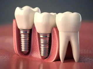 Dental Implants