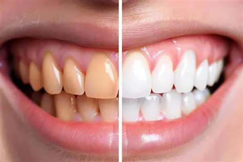 Teeth Whitening