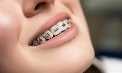 Dental Braces