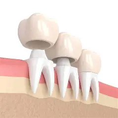 Dental Crowns